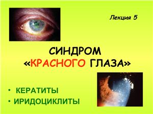 Синдром красного глаза. Кератиты, конъюктивиты