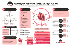 Коллектив Medless. Инфографика Инфаркт миокарда на ЭКГ