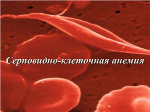 Реферат - серповидно-клеточная анемия (+презентация)