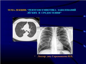 Рентгенсемиотика заболеваний лёгких и средостения