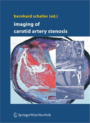 Schaller B. Imaging of Carotid Artery Stenosis
