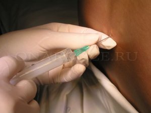 Видео - Техника выполнения эпидуральной анестезии