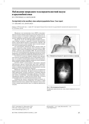 Вестник оториноларингологии 2009 №02