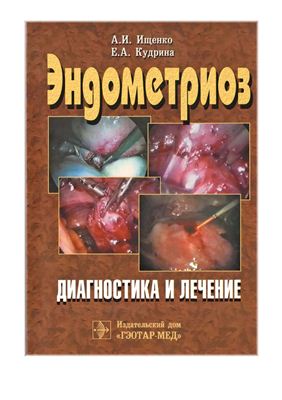 Ищенко А.И., Кудрина Е.А. Эндометриоз: диагностика и лечение