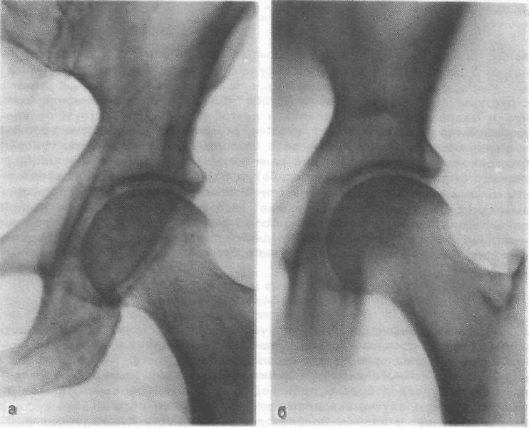 Окостенение головки бедренной кости. Вертлужная впадина тазобедренного сустава рентген. Коксартроз тазобедренного сустава рентген.